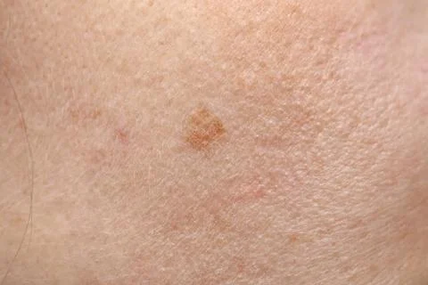 Pigmentation on the skin. Stock-Fotos