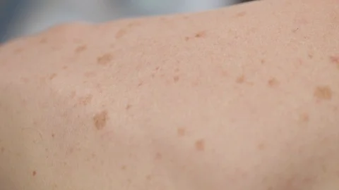 Pigmented spots on the back of a man. Stock Footage 127568264