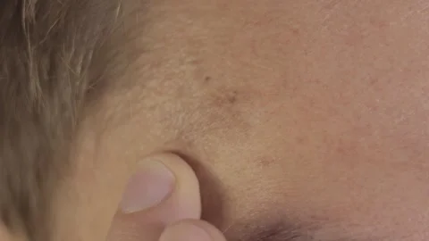 Pigmented spots Stock Footage 288115052