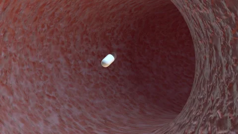 Pillcam Small Bowel Capsule Endoscopy Stock Footage 260896626