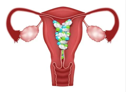 Pills inside uterus Stock Illustration