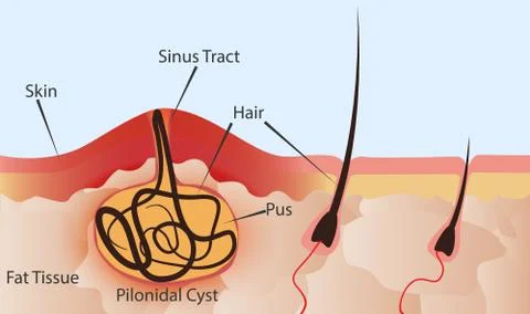Pilonidal cyst formation Stock Illustration