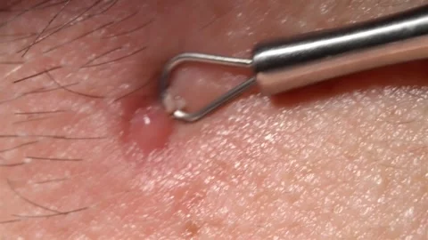 Pimple extraction with metal loop comedone tool on inflamed skin Stock Footage 337148438