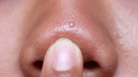 Pimple on Nose Stock Footage 116611726