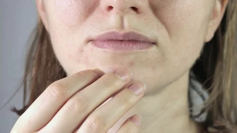 Pimple patch Stock Footage 308390523