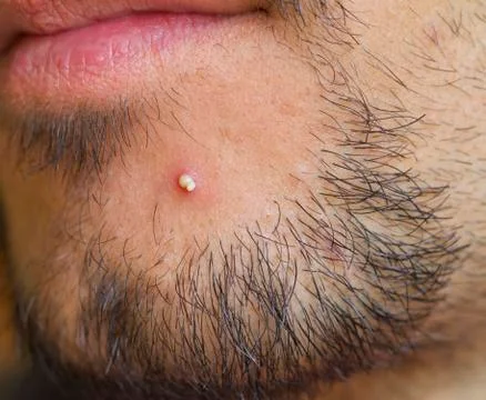 Pimple Stock Photos