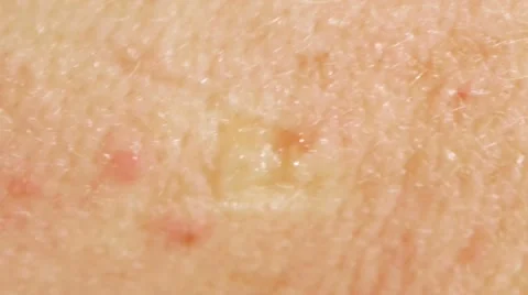 Pimple Popped Stock Footage