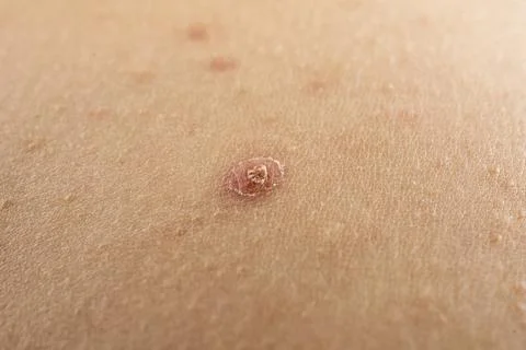 Pimple on skin with pustule and papules. Closeup of pimple with inflamed foll Stock Photos