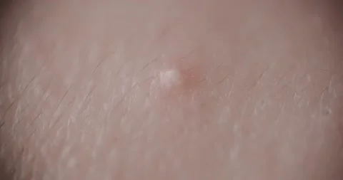 Pimple on the skin super Stock Footage 166654158