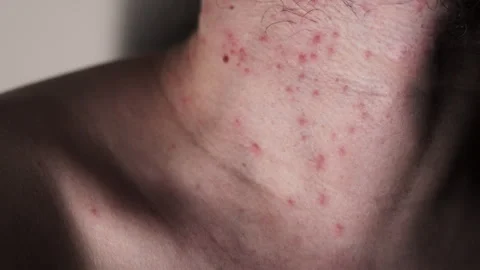 Pimples on the body, neck. Possible insect bites, allergic reaction. Video stock 244479495
