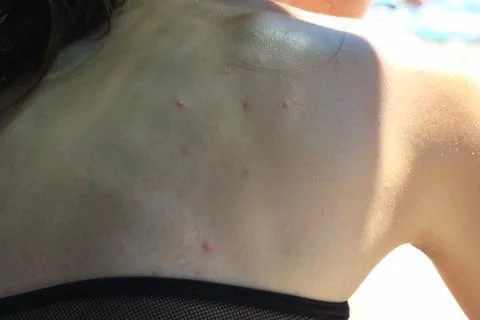 Pimples on the body 스톡 사진