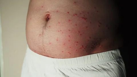Pimples on the body, stomach. Possible insect bites, allergic reaction. Video stock 244479019