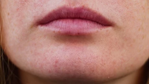 Pimples on chin. Problem skin. Acne on the face. Examination by a doctor  Video stock 99416920