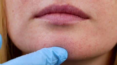 Pimples on chin. Problem skin. Acne on the face. Examination by a doctor  Video stock 99416989