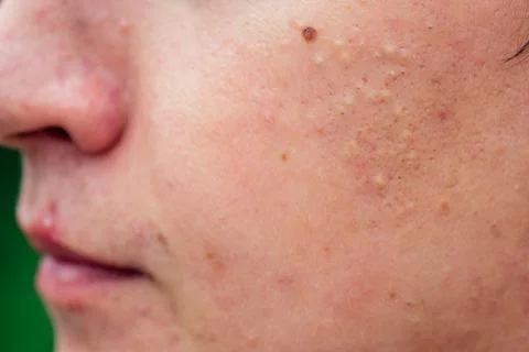 Pimples on the face of a man close-ups Stock Photos