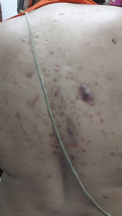 Pimples  or acne on the back of a patient Stock Footage 185832333