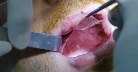 Place membrane bone surgery Video stock 70172464