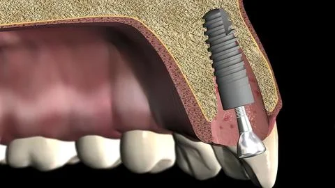 Placement and alignment of the implant Stock Illustration