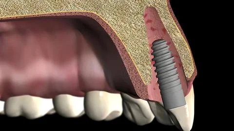 Placement and alignment of the implant Illustrazione stock