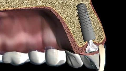 Placement and alignment of the implant Stock Illustration