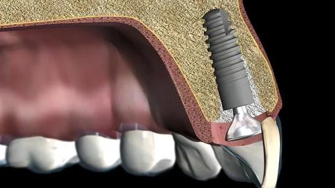 Placement and alignment of the implant Illustrazione stock