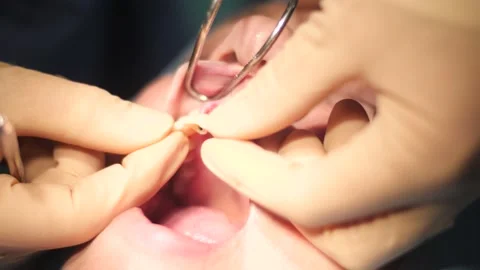 Placement of Tooth Bridge in Mouth Stock Footage 148496692