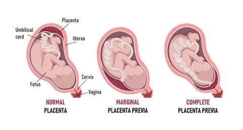 Placenta previa: normal , Partial, Marginal (Low-lying), Complete Stock Illustration