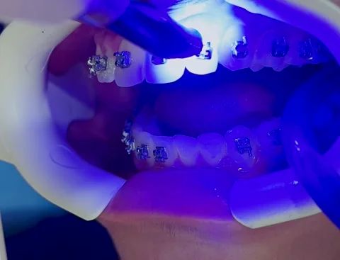 Placing the fixed retainer in Process of removing dental braces from a female Stock Footage 220024041