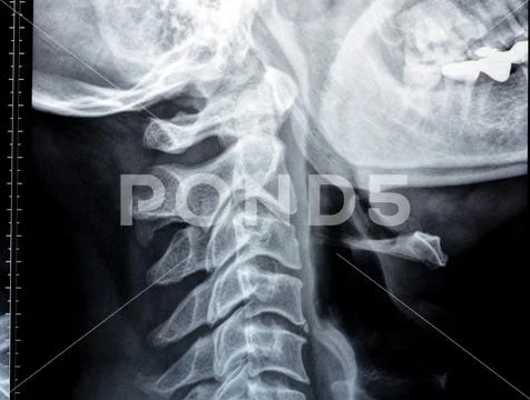 Plain X ray of cervical spine revealed straightened cervical curve ...