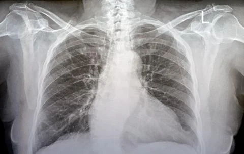 Plain x ray chest of an old woman with almost normal study of bones, lungs .. Stock Photos