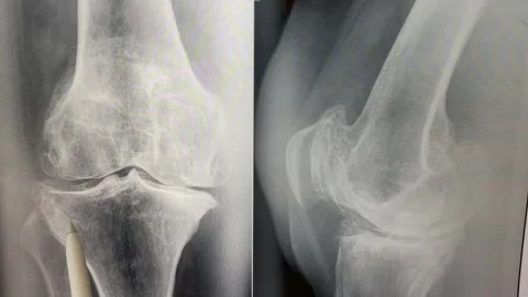 Plain X ray of the knee shows apparent joint osteoarthritis Stock Footage 245484051