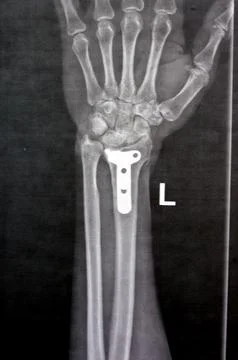 Plain x ray showing a recent fissure fracture at the lower part of a left r.. Foto stock