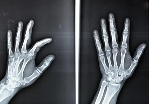Plain x ray shows avulsion fracture base of the distal phalanx of middle finger Stock Photos