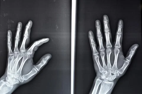 Plain x ray shows avulsion fracture base of the distal phalanx of middle finger Foto stock