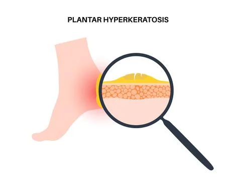 Plantar hyperhidrosis poster Stock Illustration