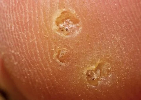 Plantar wart Stock Photos
