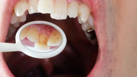 Plaque on the back of the teeth Stock Photos
