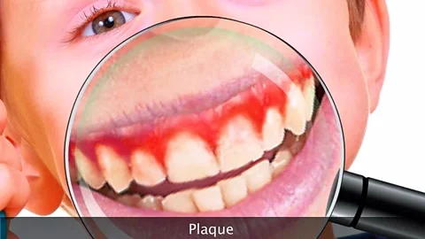 Plaque formation on human teeth Stock Footage 322538183