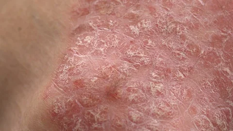 Plaque psoriasis close up Stock Footage 103784602