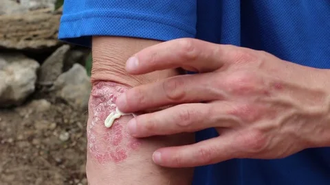 Plaque Psoriasis on elbow Stock Footage 76119333