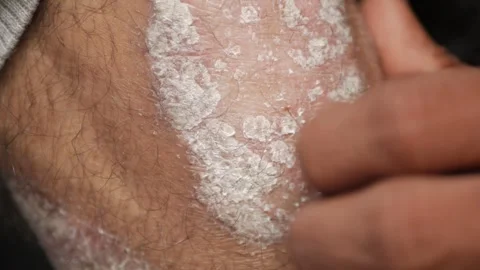 Plaque Psoriasis on man calf, itching ,dry skins pouring out Stock Footage 240243832