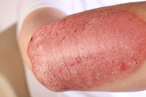 Plaque psoriasis Stock Photos