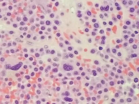 Plasmablastic anaplastic Multiple Myeloma - Close up of Plasma Cells Stock Photos