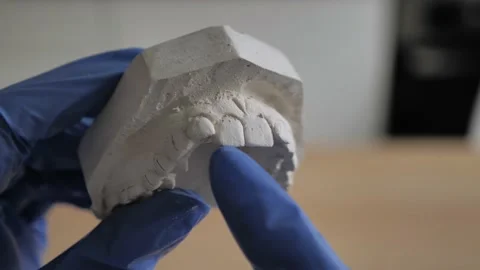 The plaster 3 d model of the maxilla in the hands of an orthodontist in blue glo Stock Footage 144671955