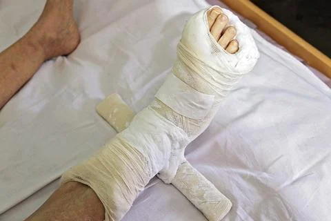 Plaster Derotational Boot on an Elderly Womans Leg 스톡 사진