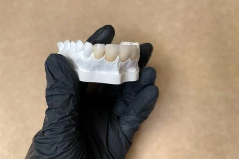 Plaster model with false ceramic or porcelain teeth in the dentist's hand in Stock Photos