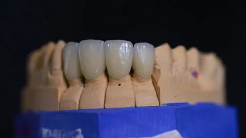 Plaster model of the jaw with dental crowns made of zirconium dioxide rotates on Stock Footage 211306316