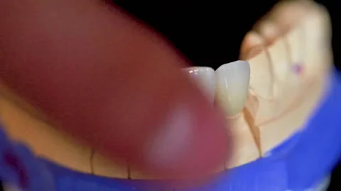 Plaster model of the jaw with four zirconia dental crowns on a black background Stock Footage 211306759
