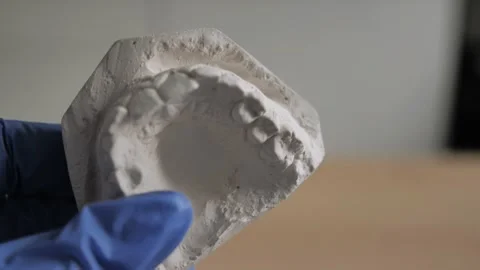 The plaster model of the maxilla in the hands of an orthodontist. orthodontist d Video stock 144687039