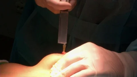 Plastic breast. Anesthesia Stock Footage 71336977